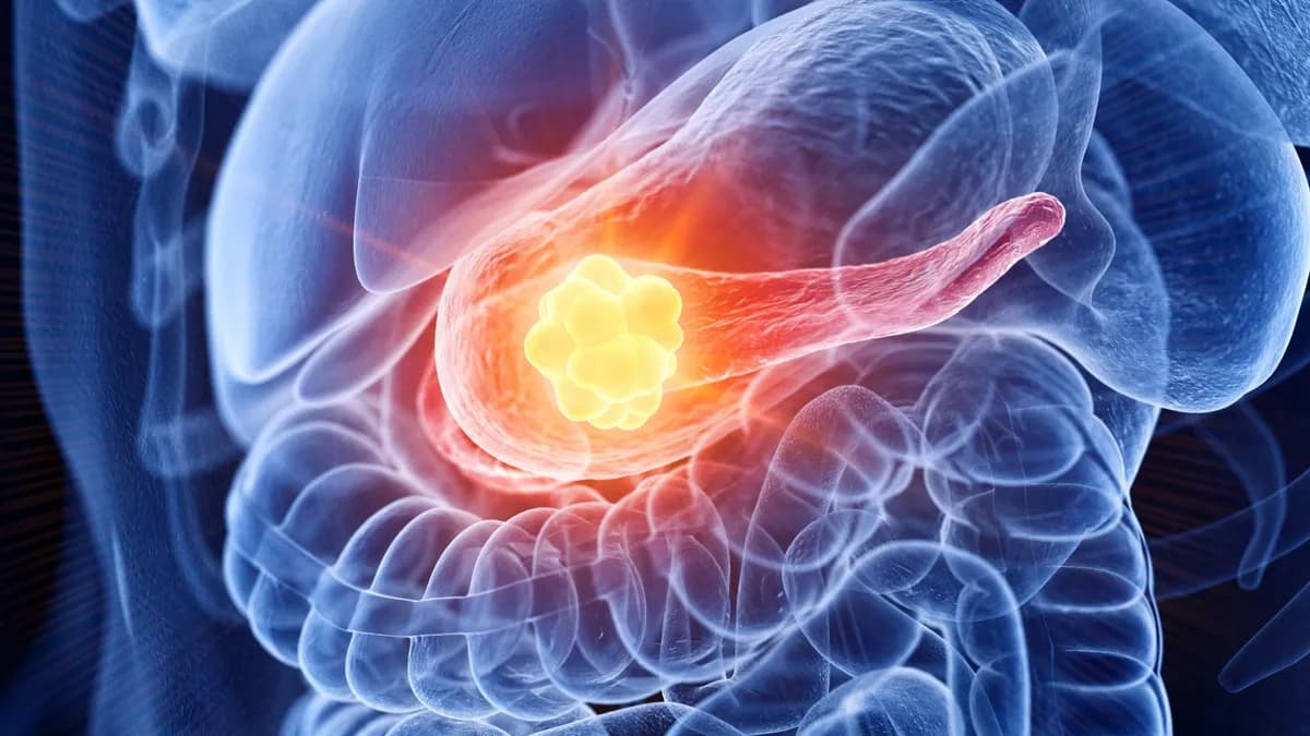 Prometedor ensayo de vacuna contra el cáncer de páncreas muestra respuestas inmunitarias en el 99% de los pacientes