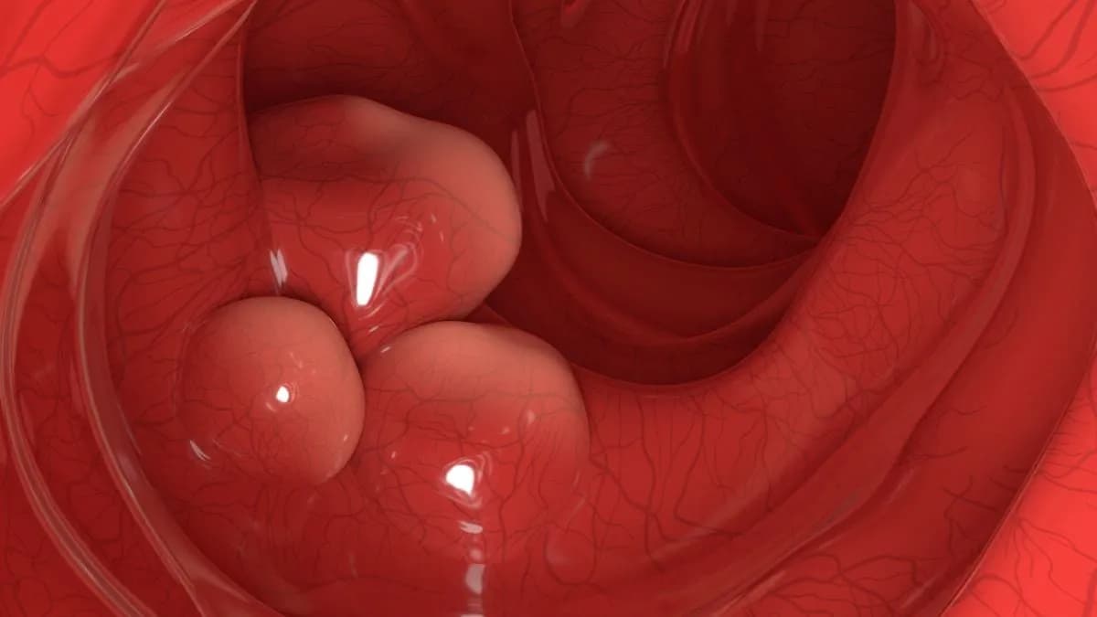 Probioticos Ingenierizados Reducen Tumores Colorrectales en Ratones